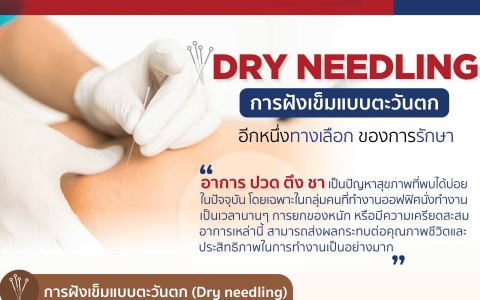 การฝังเข็มแบบตะวันตก
